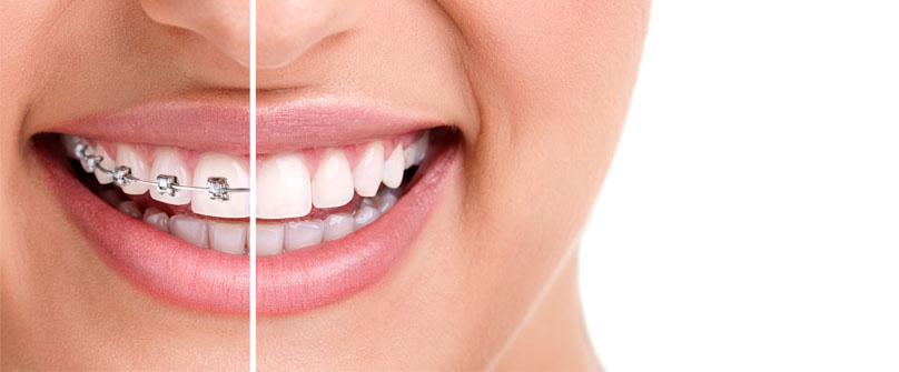 Advantages of Invisalign over traditional metal wire braces